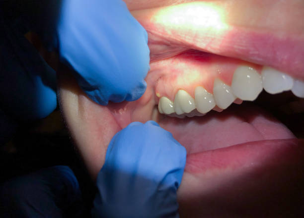 Best Emergency Tooth Extraction in Beverly, NJ